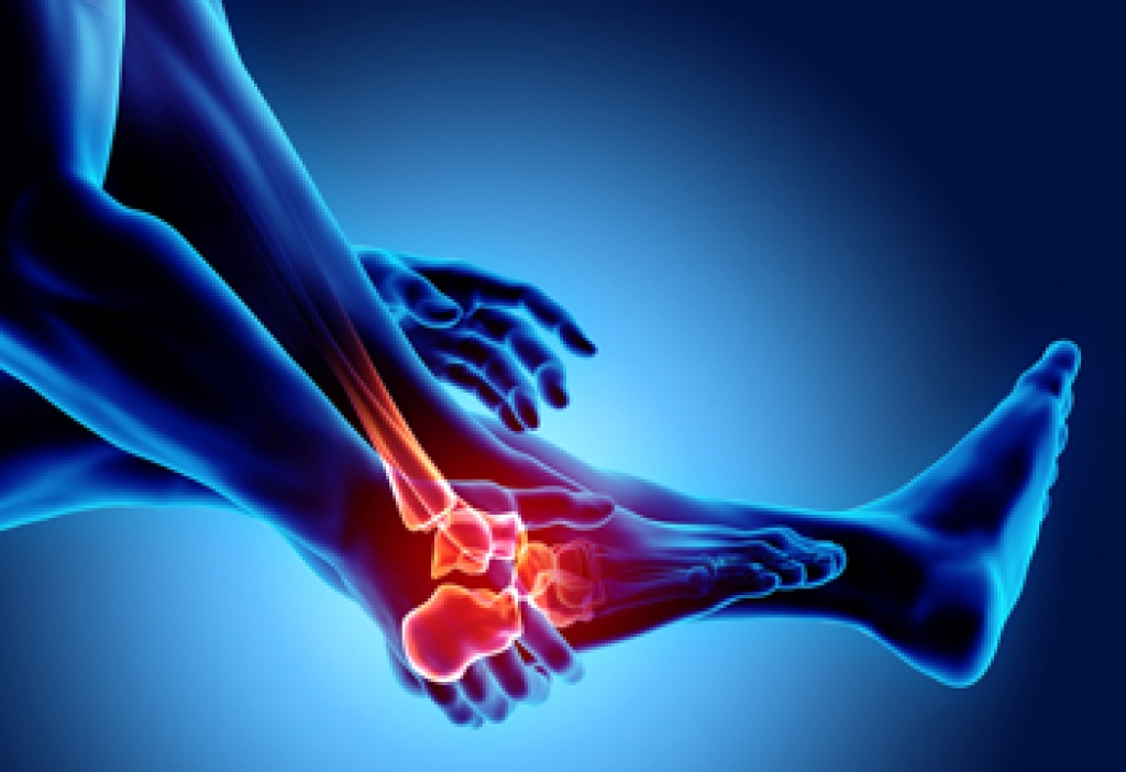 Playing Pickleball With Rheumatoid Arthritis