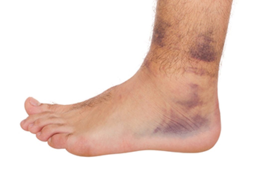 Understanding Sprains and Strains