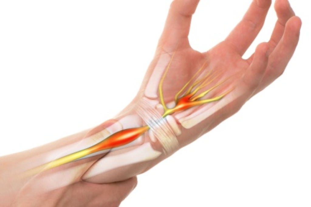 How a Chiropractor Can Help With Carpal Tunnel Syndrome